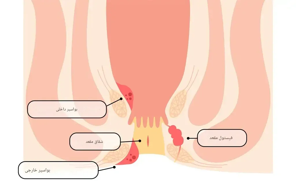 سونوگرافی فیستول مقعدی