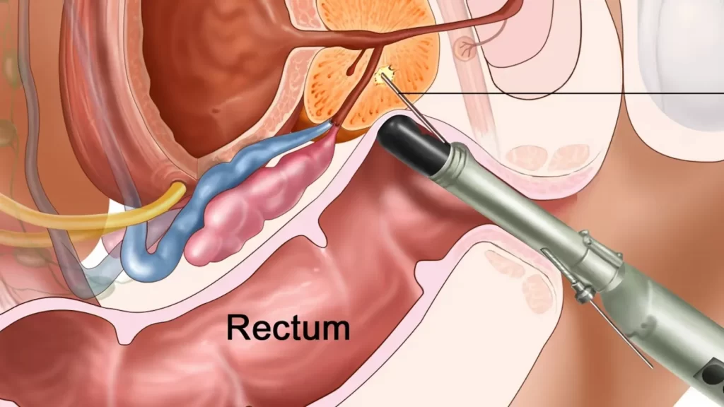 سونوگرافی ترانس رکتال
